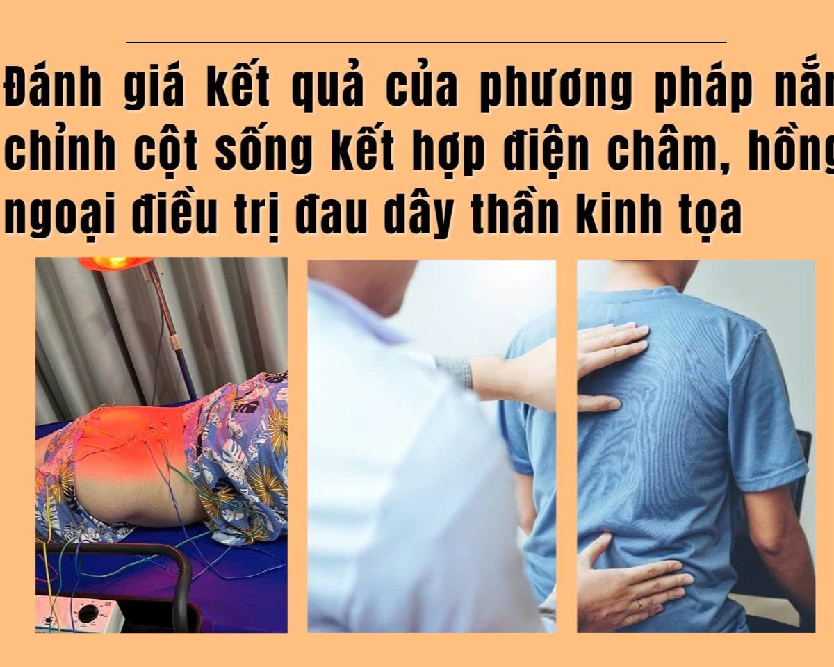 Đánh giá kết quả của phương pháp nắn chỉnh cột sống kết hợp điện châm, hồng ngoại điều trị đau dây thần kinh tọa